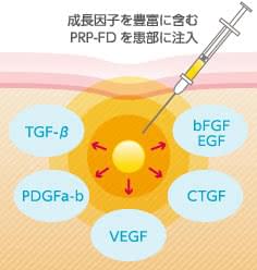 PRP-FD（PFC-FD）に豊富に含まれる、さまざまな成長因子